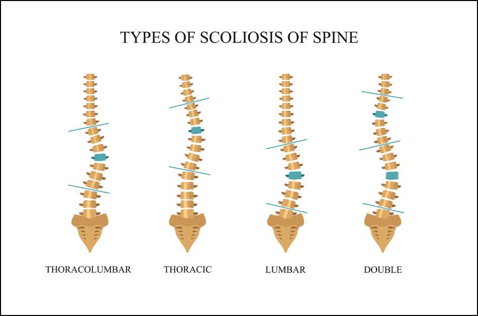 Types of scoliosis